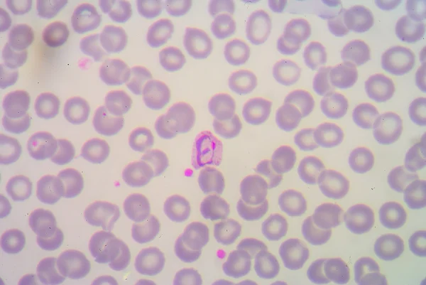 Пленки крови для паразитов малярии . — стоковое фото