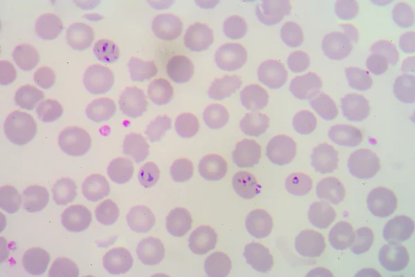 Blood films for Malaria parasite. — Stock Photo, Image