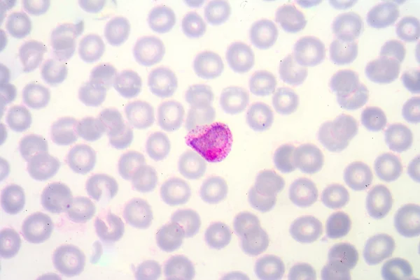 Blood films for Malaria parasite. — Stock Photo, Image