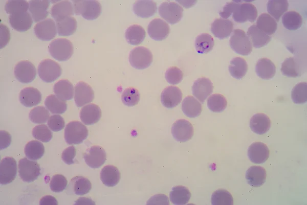 Film di sangue per parassiti della malaria . — Foto Stock