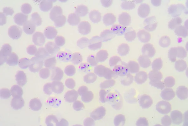 Blood films for Malaria parasite. — Stock Photo, Image