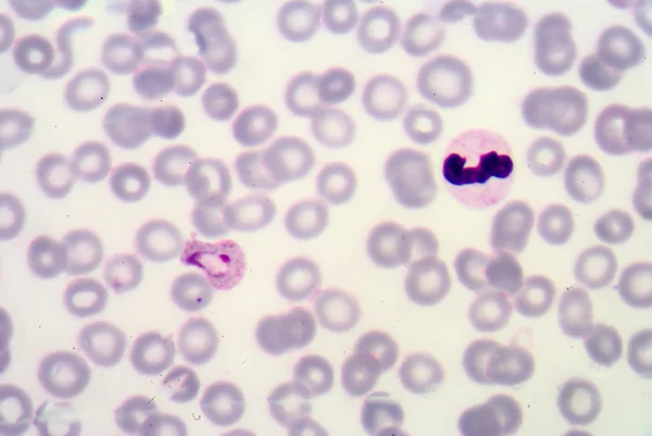 Blood films for Malaria parasite. — Stock Photo, Image