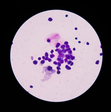 Beyin omurilik sıvısı içinde boyama wright beyaz kan hücreleri