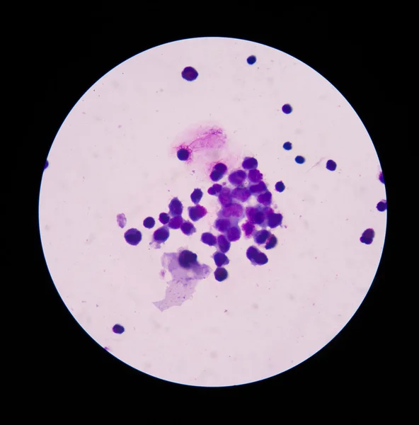 Witte bloedcellen in wright kleuring in cerebrospinaal vocht — Stockfoto