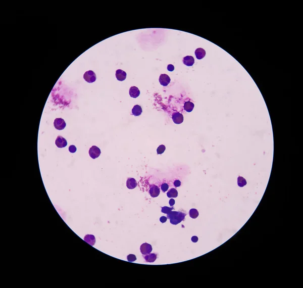 White blood cells  in wright staining in Cerebrospinal fluid