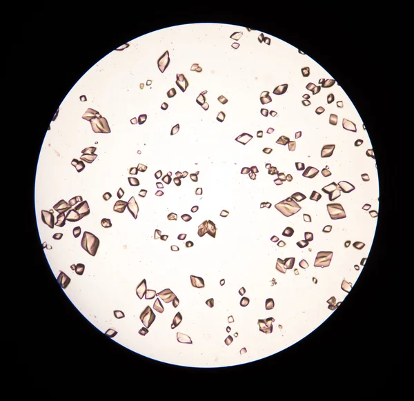 Uric acid crystal in urine. — Stock Photo, Image