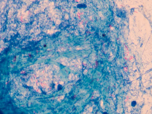 Micobatterio tubercolosi globuli rossi . — Foto Stock
