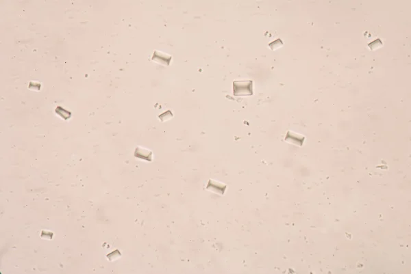 Cristalli di fosfato triplo nelle urine umane — Foto Stock