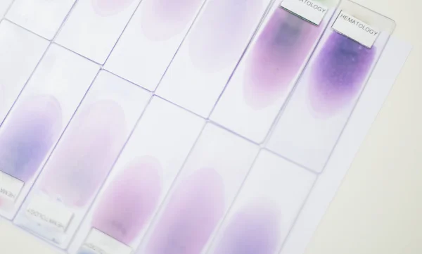kan smear testi ya da kan film. İki Slayt ve bir damla kan bir