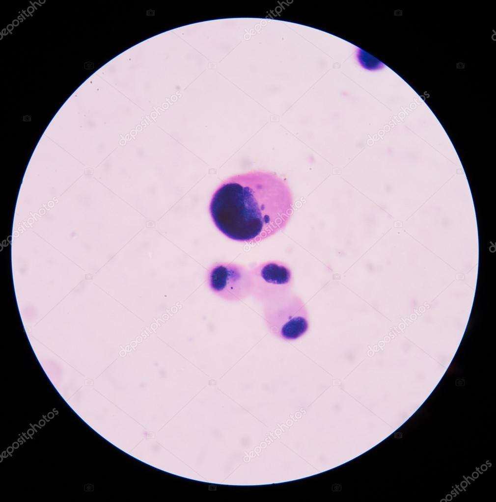 Mesothelial cells in body fluid. — Stock Photo © toeytoey ...