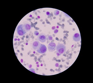 Mesothelial Malign hücreler birden çok çekirdek ile