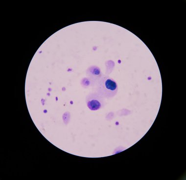 Mesothelial Malign hücreler birden çok çekirdek ile