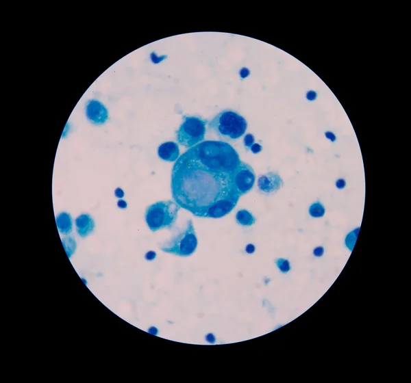 Злокачественные клетки мезотелий с множественными ядрами — стоковое фото