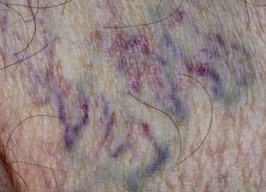 Derinin altındaki varisli damarların yakın çekimi.