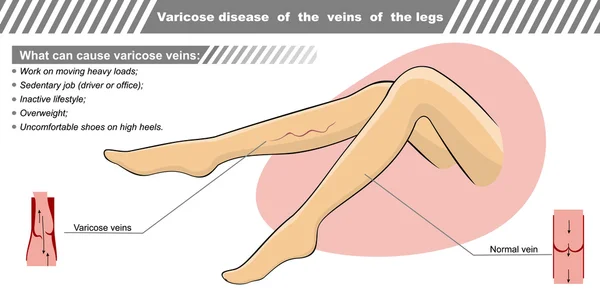 Εικονογράφηση φορέας μιας ασθένειας κιρσώδεις φλέβες των ποδιών. — Διανυσματικό Αρχείο