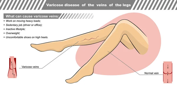 Ilustración vectorial una enfermedad varicosa de las venas las piernas . — Archivo Imágenes Vectoriales