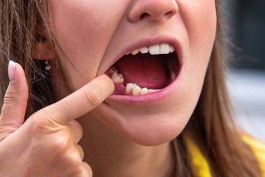 Alt çenesinde dişi olmayan genç bir kadın. Kayıp diş. Diş çekildikten sonra implant yapılmasını bekliyor.