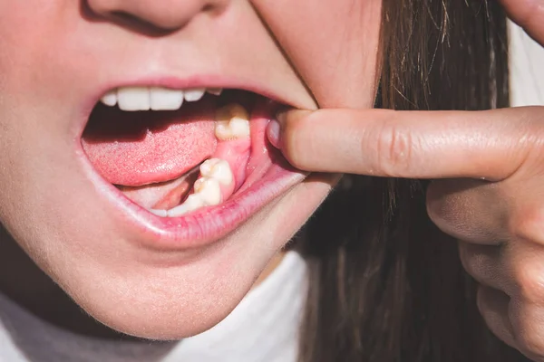 Mujer joven mostrando la boca sin dientes en la mandíbula inferior. Falta un diente. Esperando un implante después de la extracción dental —  Fotos de Stock