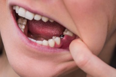 Tek bir diş implantı. Alt çenesinde dişi olmayan genç bir kadın. Kayıp diş. Diş çekildikten sonra implant.. 