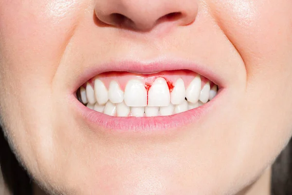 Primer plano de la boca de la mujer con encías sangrantes — Foto de Stock