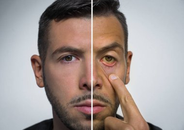 Erkek yüzü ikiye bölünmüş. Biri sağlıklı, diğeri sağlıksız. Kötü alışkanlıklara karşı iyi alışkanlıklar. Alkol zararlı. Karaciğer hastalığı. Sarılık, hepatit, hepatit, siroz, karaciğer yetmezliği. Sarımsı gözler ve ten