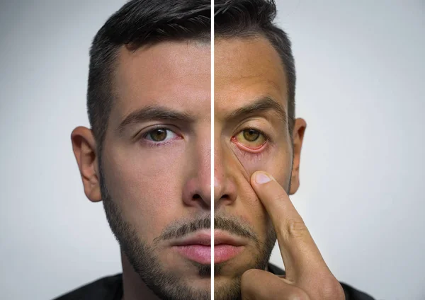 Man face divided into two parts one healthy and one unhealthy. Bad habits vs good habits. Alcohol harm. Liver disease. Jaundice, hepatosis, hepatitis, cirrhosis, liver failure. Yellowish eyes and skin — Stock Photo, Image