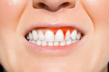 Dişetleri kanayan bir kadın. Periodontal hastalık, avitaminoz, diş eti iltihabı, iskorbüt.