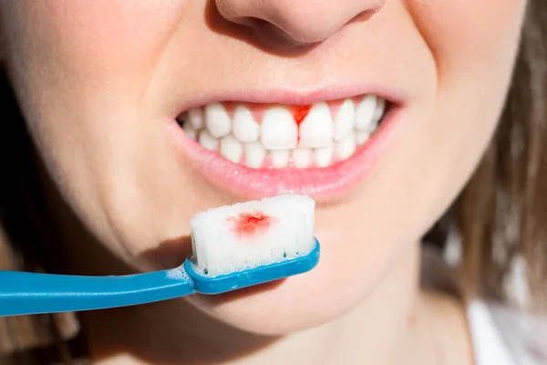 Mulher com sangramento gengival durante a escovação dos dentes. Problema da escova de dentes. Doença periodontal, avitaminose, gengivite, escorbuto — Fotografia de Stock