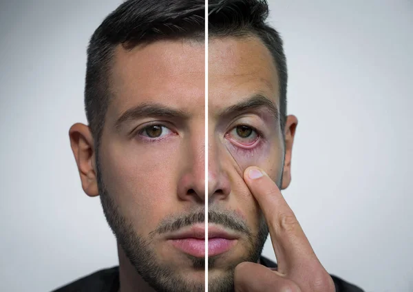 Man face divided into two parts one fresh and one with hangover. Before party and after party. Alcohol harm. Bad habits vs good habits. Alcoholism concept. Healthy lifestyle vs unhealthy lifestyle. — Stock Photo, Image