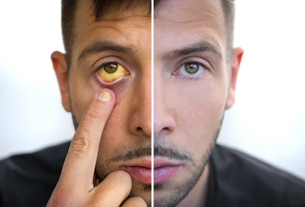 Man face divided into two parts one healthy and one unhealthy. Yellowish eyes and skin. Bad habits vs good habits. Jaundice, hepatitis, cirrhosis, liver failure. Risk factors of alcohol drinking