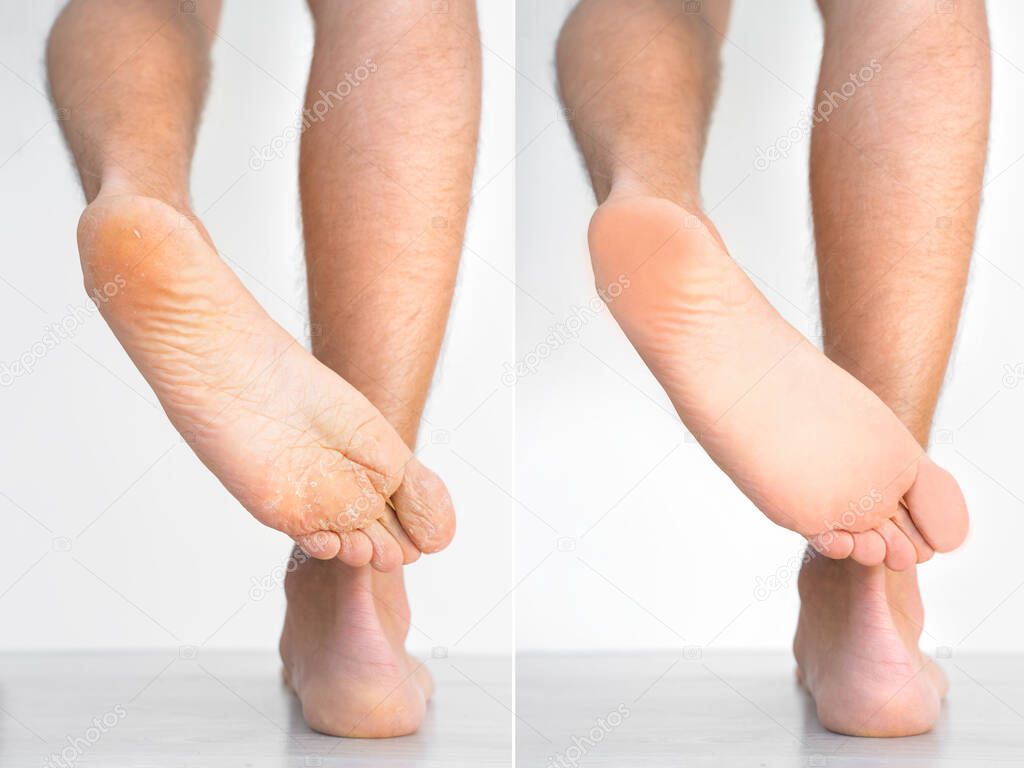 Mans feet with dry skin before and after treatment. Fungal infection or athletes foot, dry skin, dermatitis, eczema, psoriasis or sweaty feet. Health care concept