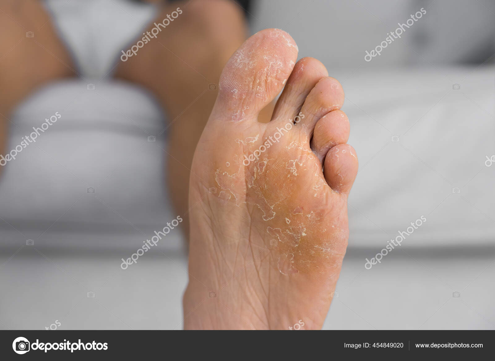 Close up of peeling and cracked foot. Fungal infection or athletes foot dry skin dermatitis eczema psoriasis allergic reaction sweaty feet or dehydration Stock Photo dariakulkova.gmail 454849020