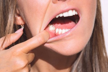 Genç bir kadın alt çenesinde dişsiz olarak ağzını gösteriyor. Dişi eksik, dişi yok. Diş çekildikten sonra implant yapılmasını bekliyor.