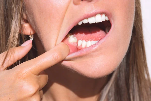 Young woman showing her mouth without tooth on lower jaw. Missing tooth, no tooth. Waiting an implant after tooth extraction