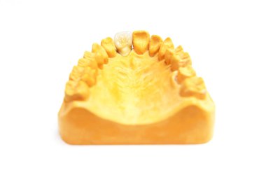 Diş implantı yapıyorum. Çene modeli kayıp bir dişin doğru restorasyonu için.