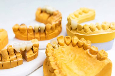 Diş implantları. Takma dişleri olan bir adamın sahte çenesi. Protez dişler..