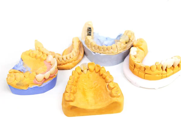 Implantacja Zębów Produkcja Protetycznych Zębów Laboratorium Stomatologicznym Szczęki Zębami Białym — Zdjęcie stockowe