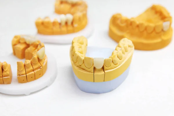 Implanty Dentystyczne Sztuczne Zęby Układzie Szczęki Przywracanie Zębów Klinice Stomatologicznej — Zdjęcie stockowe