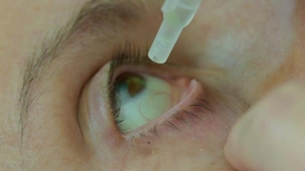 Static Shot Footage Shows Person Dropping Artificial Tears His Eye — Vídeo de Stock