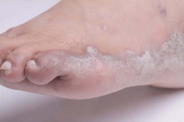 Beyaz arka planda kronik sedef hastalığından muzdarip bir kadının bacakları. Hastanın cildinde kızarıklık ve pullanma var. Dermatolojik sorunlar. Kuru cilt. İzole edilmiş