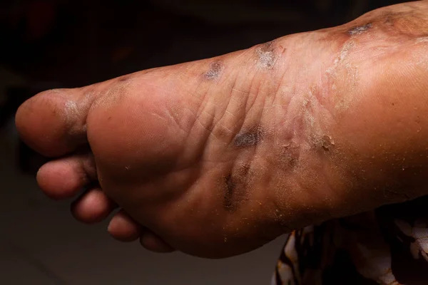 Closeup of the foots sole of a woman suffering from chronic psoriasis on a black background. Closeup of rash and scaling on the patient\'s skin. Dermatological problems. Dry skin Isolated