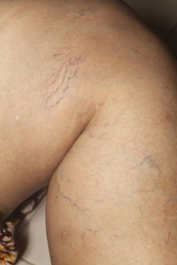 Yaşlı kadınlarda varisli damarlar, Makro şutu kapat, seçici odak, Asya vücut parçası, sağlık sigortası konsepti