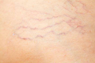 Yaşlı kadınlarda varisli damarlar, Makro şutu kapat, seçici odak, Asya vücut parçası, sağlık sigortası konsepti