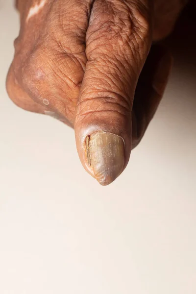 Fungus Infection on Nails of old woman\'s thumb.