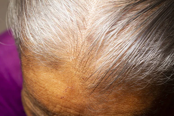 Detailní Tenké Vlasy Hlavě Staré Ženy — Stock fotografie
