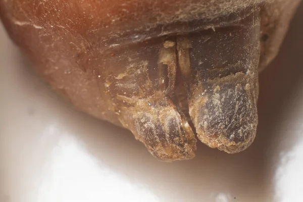 Zakażenie Grzybicą Paznokciach Kciuka Starszej Kobiety Zamyka Się — Zdjęcie stockowe