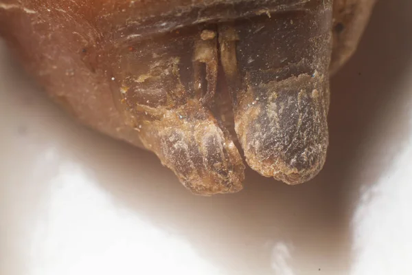 Грибковая Инфекция Ногтях Большого Пальца Старухи Возникает Вопрос — стоковое фото