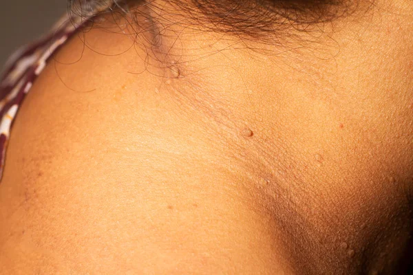 Close-up the skin tags on neck woman skin.close up of wart.