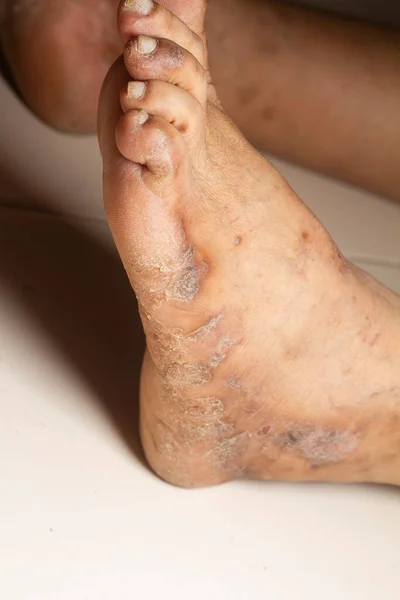 Closeup of the legs of a woman suffering from chronic psoriasis on a white background. Closeup of rash and scaling on the patient\'s skin. Dermatological problems. Dry skin.