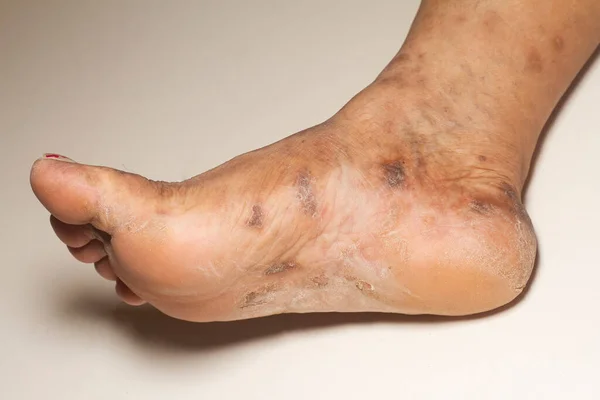 Closeup of the legs of a woman suffering from chronic psoriasis on a white background. Closeup of rash and scaling on the patient\'s skin. Dermatological problems. Dry skin.